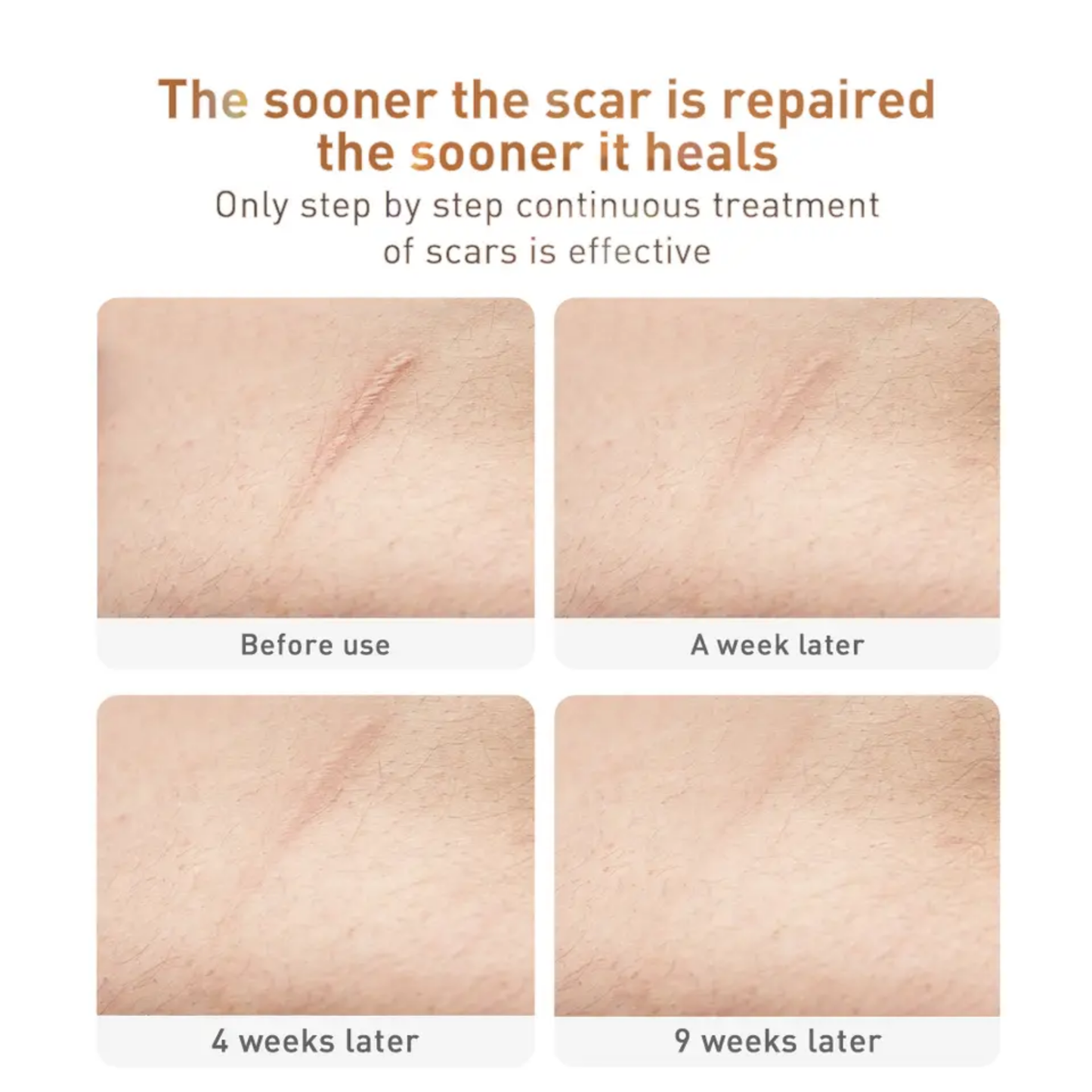 LANBENA scar and acne mark removal gel for skin repairing scar removal wholesale