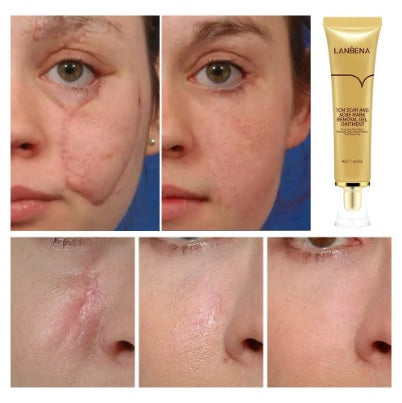 LANBENA scar and acne mark removal gel for skin repairing scar removal wholesale