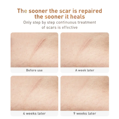 LANBENA scar and acne mark removal gel for skin repairing scar removal wholesale